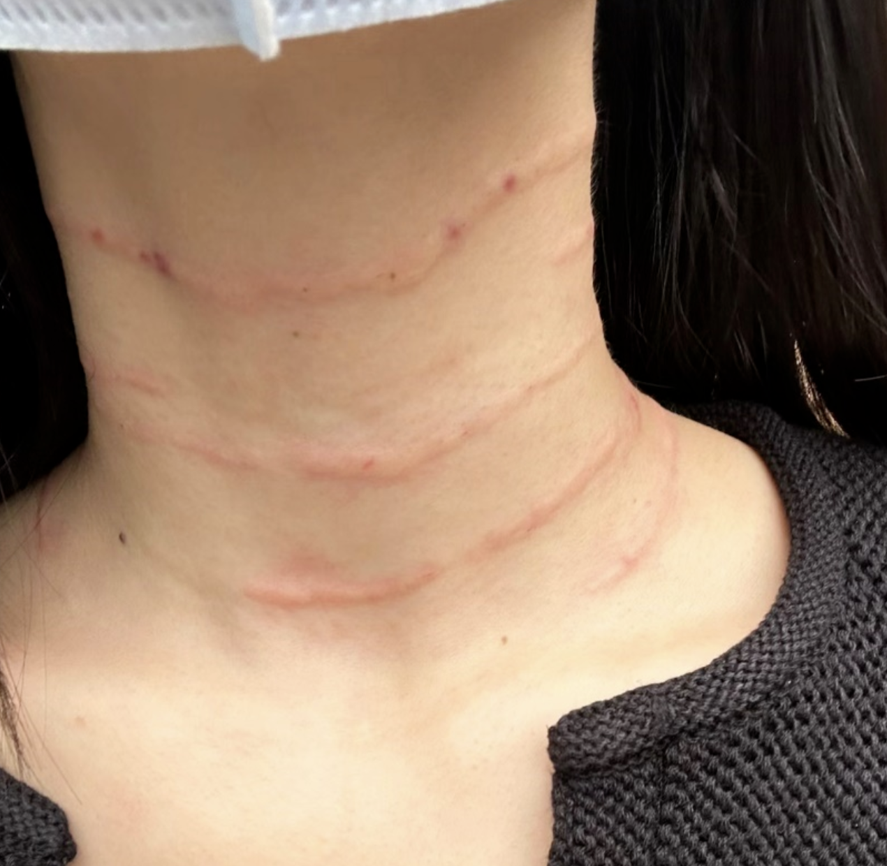 爱美客失速：爆品“嗨体”隐忧不断，净利增幅创7年新低