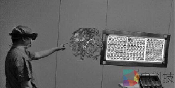 医生戴VR眼镜做脑瘤手术 又快又有准头