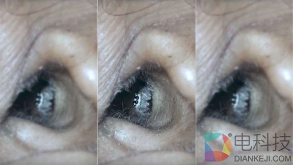 印度女子头疼 医生竟从耳朵里掏出活蜘蛛