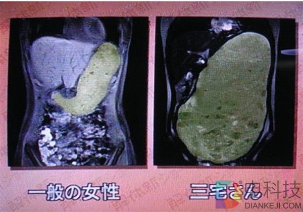 为什么大胃王这么能吃而且还不胖？结果感人